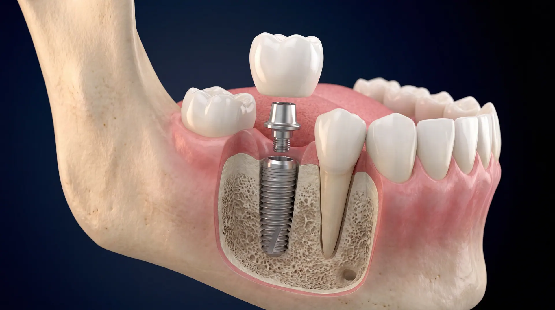 Dental Implants